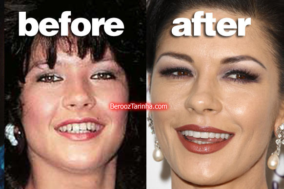 teeth zeta چهره باورنکردنی این ستاره ها قبل و بعد از مشهور شدن
