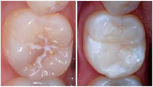پوسیدگی دندان کودکان, پیشگیری از پوسیدگی دندان کودکان, مهمترین عامل پوسیدگی دندان,بیماری های کودکان ,بیماری نوزاد ,بیماری کودک