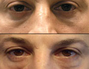 درمان ورم چشم با رژیم گیاهی , خاصیت روغن سیاه دانه برای پف زیر چشم 