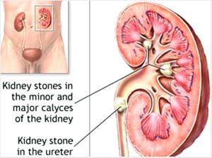 سنگ‌ کلیه‌ ـ kidney stones