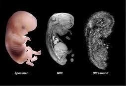 سونو گرافی سه بعدی در چه ماهی انجام میگیرد , سونوگرافی سه بعدی واسه چیه جنینه 