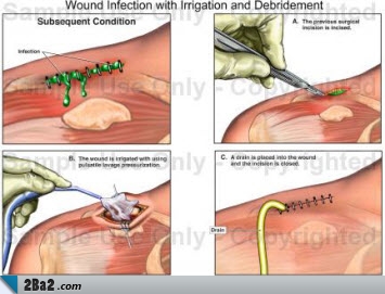 Surgical-wound-infection3.jpg (355×271)