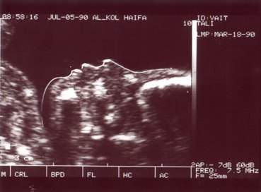 Pregnancy Ultrasound Picture : week 15