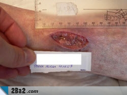 Surgical-wound-infection5.jpg (250×187)