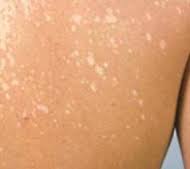 پیش گیری از حساسیت پوستی در فصل گرما 