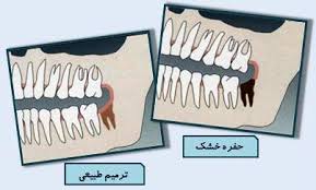 حفره خشک دندان 