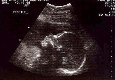 Pregnancy Ultrasound Picture : week 24