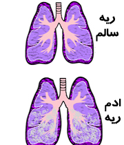 ادم ریوی (Pulmonary edema)‏ 