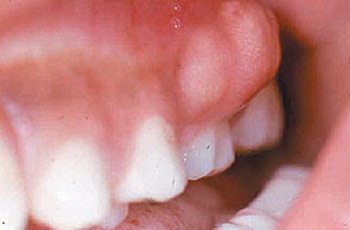 زخم دهان , درمان زخم زبان , بیماریهای زبان 