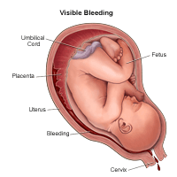 خونریزی آشکار( قابل رویت) در دوران بارداری