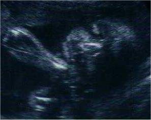 Pregnancy Ultrasound Picture : week 27