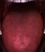 بیماری سوزش زبان
