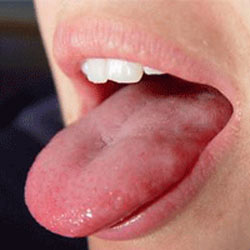 فیبروم روی زبان 