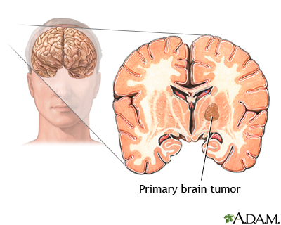 آموزش به بیمار در تومور مغزی