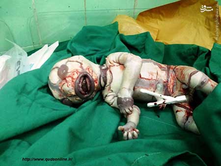 تولد نوزادی‌ با‌‌ بیماری‌ وحشتناک‌ در داراب+ تصاویر(+18)