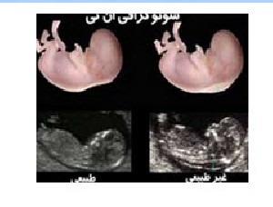 عکس جنین در ۱۱ هفته 