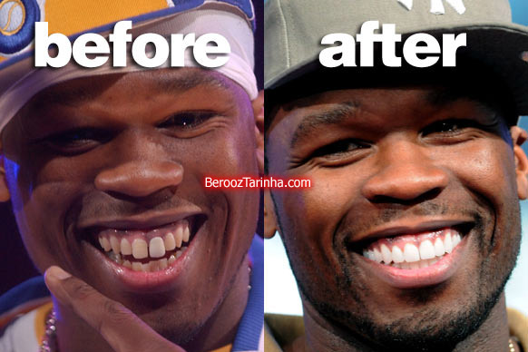 teeth 50 چهره باورنکردنی این ستاره ها قبل و بعد از مشهور شدن