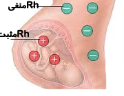 مادر با rh منفی و جنین با rh مثبت