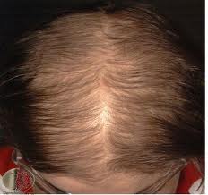 علت ریزش مو در زنان جوان , ریزش مو در زنان , درمان شدید ریزش موی خانومها 