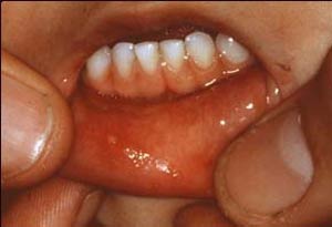 درمان زخم زبان کودک , تاول سقف دهان , ضخم روی زبان کودکان 