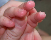 نوک انگشتان دست و پای پسر 3 ساله پوسته می اندازد 