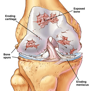 knee-osteoarthritis.jpg
