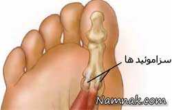 علت درد انگشت شست پای راست , ارتروز انگشت پا , گرفتگی در ناحیه کمر وانگشت شست پای راست 