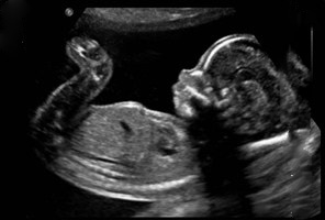 اصطلاحات سونوگرافی بارداری , سفالیک در سونوگرافی , تفسیر سونوگرافی بارداری 