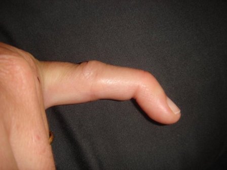 انگشت چکشی(Mallet finger)