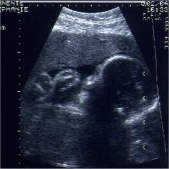 Pregnancy Ultrasound Picture : week 30