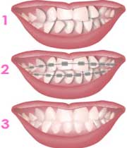 ارتودنسی,درمان دندان های نامرتب,درمان دندان های کح و کوله