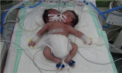 تولد نوزاد دوسر در بیمارستان دکتر گنجویان دزفول