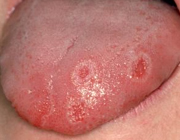 بیماری زخم زبان