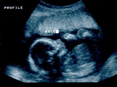 Pregnancy Ultrasound Picture : week 18