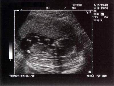 Pregnancy Ultrasound Picture : week 14