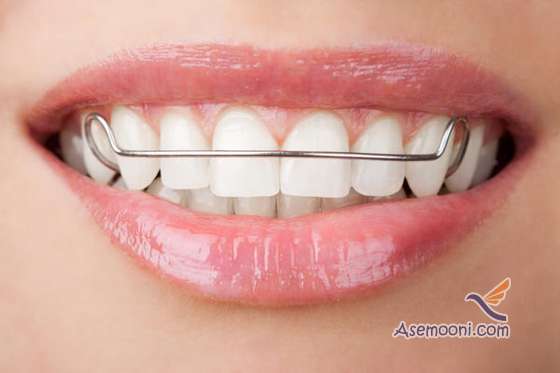 types of orthodontic procedures4 انواع روش های ارتودنسی