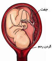 چسبندگی جفت , راههای جلوگیری ازچسبندگی جنین قبل بارداری , چسبندگی رحم در بارداری 
