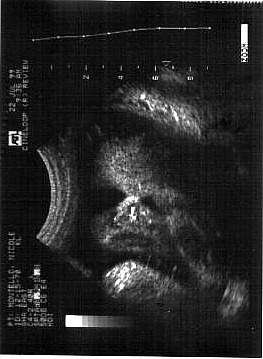 Pregnancy Ultrasound Picture : week 35