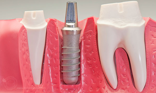 دندان مصنوعی تکی , پرتز متحرک ژله ای , دندان مصنوعی ژله ای چیست 