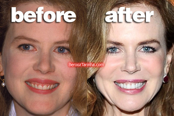 teeth nicole چهره باورنکردنی این ستاره ها قبل و بعد از مشهور شدن