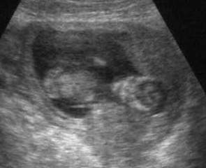 Pregnancy Ultrasound Picture : week 13