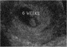 Pregnancy Ultrasound Picture : week 6