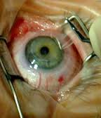 فواید و مضرات عملیات لیزری چشم 
