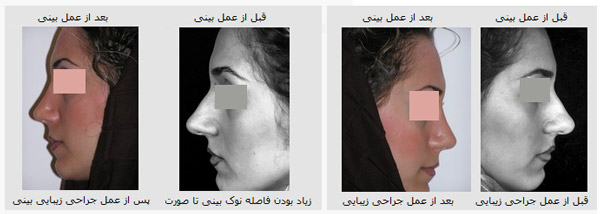 ,جراحی زیبایی بینی بدون درد و کبودی,آموزش آرایش آرایش صورت آرایش چشم گریم مدل ابرو