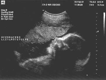 Pregnancy Ultrasound Picture : week 31