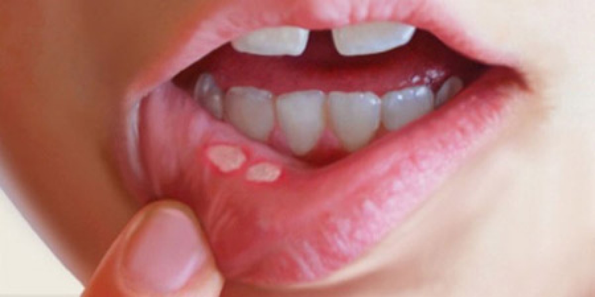 بیمار ی زبان , ﻓﻨﮕﺲ ﺩﻫﺎﻥ , بیماریهای دهان و زبان 