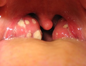 tonsils.jpg