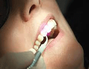 لیزر، گزینه‌ای موثر و ایمن در دندانپزشكی (2)