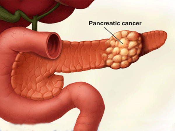 سرطان پانکراس: نشانه ها، روش های پیشگیری، شناسایی، و درمان سرطان لوزالمعده
