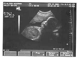 Pregnancy Ultrasound Picture : week 26